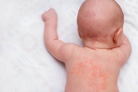 What is Eczema?