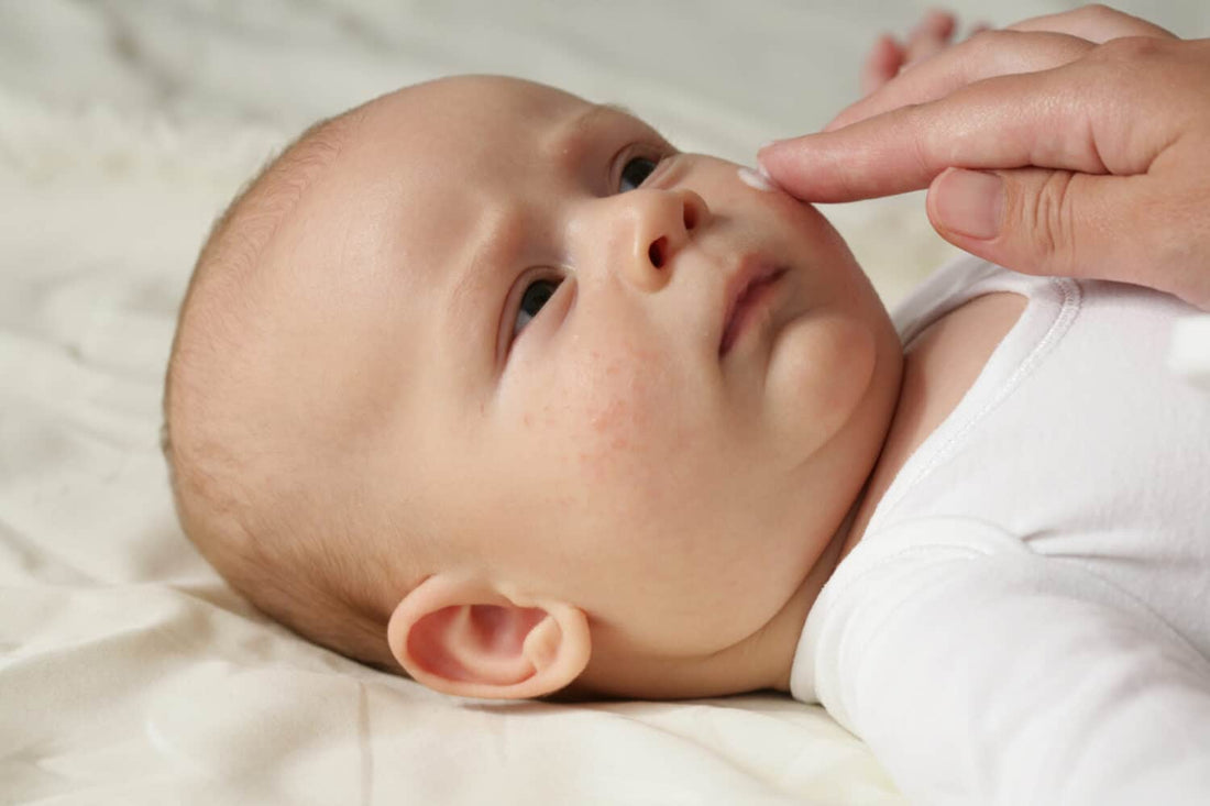 How to manage my baby's eczema?